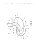 STOMACH BYPASS FOR THE TREATMENT OF OBESITY diagram and image