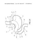 STOMACH BYPASS FOR THE TREATMENT OF OBESITY diagram and image