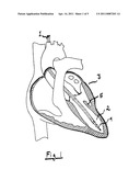 SYSTEM FOR IMPROVING DIASTOLIC DYSFUNCTION diagram and image