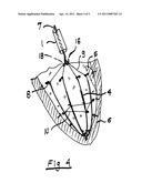 SYSTEM FOR IMPROVING DIASTOLIC DYSFUNCTION diagram and image