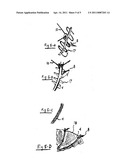 SYSTEM FOR IMPROVING DIASTOLIC DYSFUNCTION diagram and image