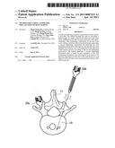 METHOD FOR GUIDING SYMMETRIC IMPLANTATION OF BONE SCREWS diagram and image