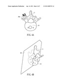 METHOD FOR GUIDING SYMMETRIC IMPLANTATION OF BONE SCREWS diagram and image