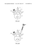 METHOD FOR GUIDING SYMMETRIC IMPLANTATION OF BONE SCREWS diagram and image