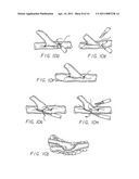 METHOD AND APPARATUS FOR PERFORMING MINIMALLY INVASIVE CARDIAC PROCEDURES diagram and image