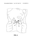 Device for Hygienic Extraction of an Acne Related Impaction diagram and image