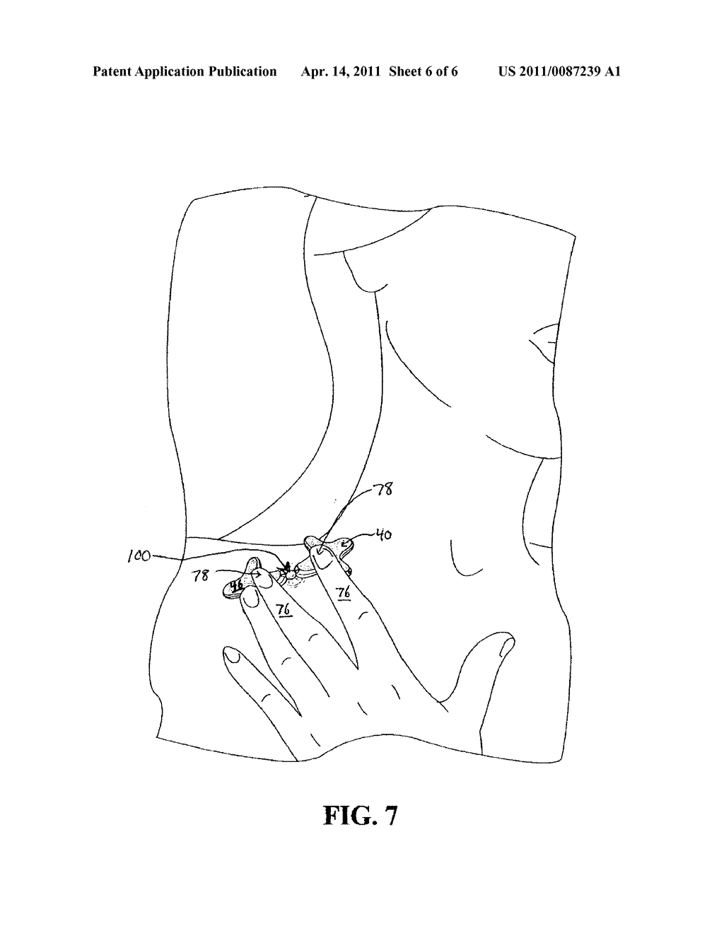 Device for Hygienic Extraction of an Acne Related Impaction - diagram, schematic, and image 07