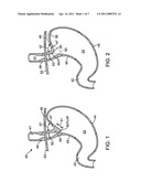 APPARATUS AND METHOD FOR MANIPULATING STOMACH TISSUE AND TREATING GASTROESOPHAGEAL REFLUX DISEASE diagram and image