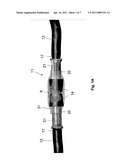 Anastomosis Device diagram and image