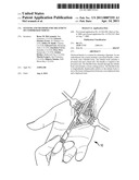 SYSTEMS AND METHODS FOR TREATMENT OF COMPRESSED NERVES diagram and image