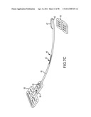 SYSTEMS AND METHODS FOR TREATMENT OF COMPRESSED NERVES diagram and image