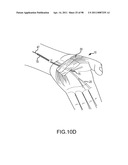 SYSTEMS AND METHODS FOR TREATMENT OF COMPRESSED NERVES diagram and image