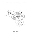 SYSTEMS AND METHODS FOR TREATMENT OF COMPRESSED NERVES diagram and image