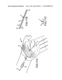 SYSTEMS AND METHODS FOR TREATMENT OF COMPRESSED NERVES diagram and image