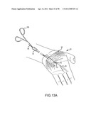 SYSTEMS AND METHODS FOR TREATMENT OF COMPRESSED NERVES diagram and image