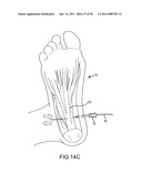 SYSTEMS AND METHODS FOR TREATMENT OF COMPRESSED NERVES diagram and image