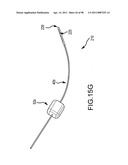 SYSTEMS AND METHODS FOR TREATMENT OF COMPRESSED NERVES diagram and image