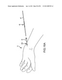 SYSTEMS AND METHODS FOR TREATMENT OF COMPRESSED NERVES diagram and image