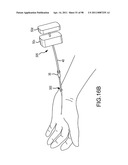 SYSTEMS AND METHODS FOR TREATMENT OF COMPRESSED NERVES diagram and image