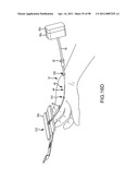 SYSTEMS AND METHODS FOR TREATMENT OF COMPRESSED NERVES diagram and image