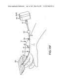 SYSTEMS AND METHODS FOR TREATMENT OF COMPRESSED NERVES diagram and image