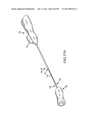 SYSTEMS AND METHODS FOR TREATMENT OF COMPRESSED NERVES diagram and image