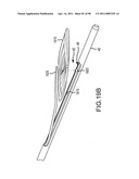 SYSTEMS AND METHODS FOR TREATMENT OF COMPRESSED NERVES diagram and image