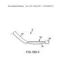 SYSTEMS AND METHODS FOR TREATMENT OF COMPRESSED NERVES diagram and image