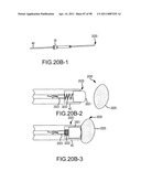 SYSTEMS AND METHODS FOR TREATMENT OF COMPRESSED NERVES diagram and image