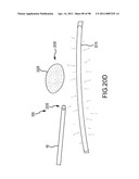 SYSTEMS AND METHODS FOR TREATMENT OF COMPRESSED NERVES diagram and image