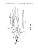 SYSTEMS AND METHODS FOR TREATMENT OF COMPRESSED NERVES diagram and image