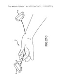 SYSTEMS AND METHODS FOR TREATMENT OF COMPRESSED NERVES diagram and image