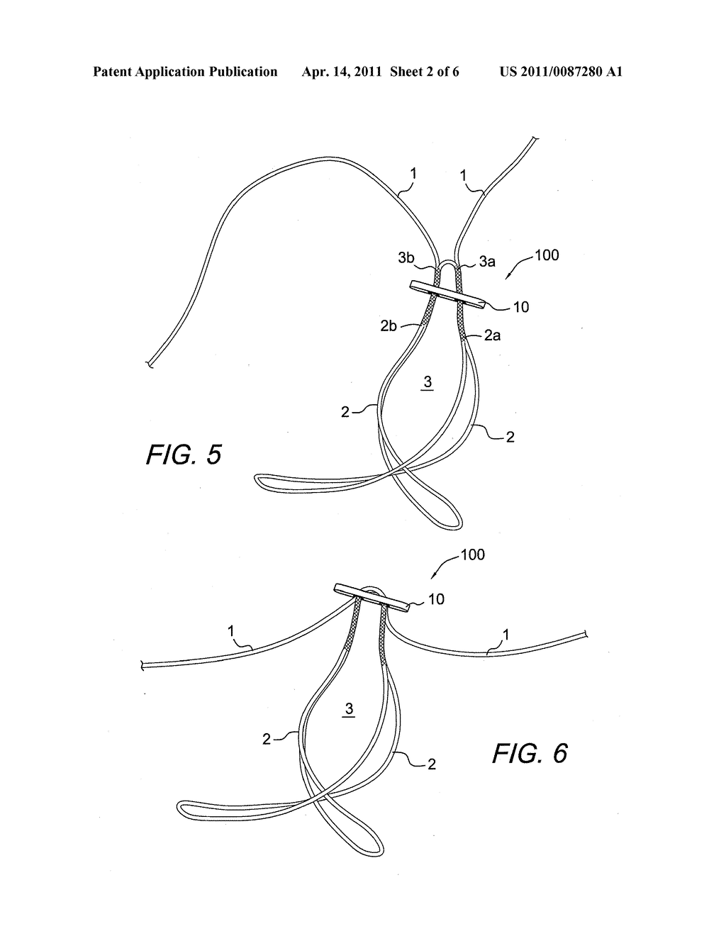 Z-SHAPED BUTTON FOR TISSUE REPAIR - diagram, schematic, and image 03