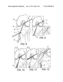 Z-SHAPED BUTTON FOR TISSUE REPAIR diagram and image