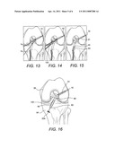 Z-SHAPED BUTTON FOR TISSUE REPAIR diagram and image