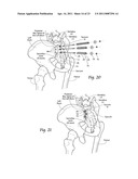 Systems and methods for the fusion of the sacral-iliac joint diagram and image