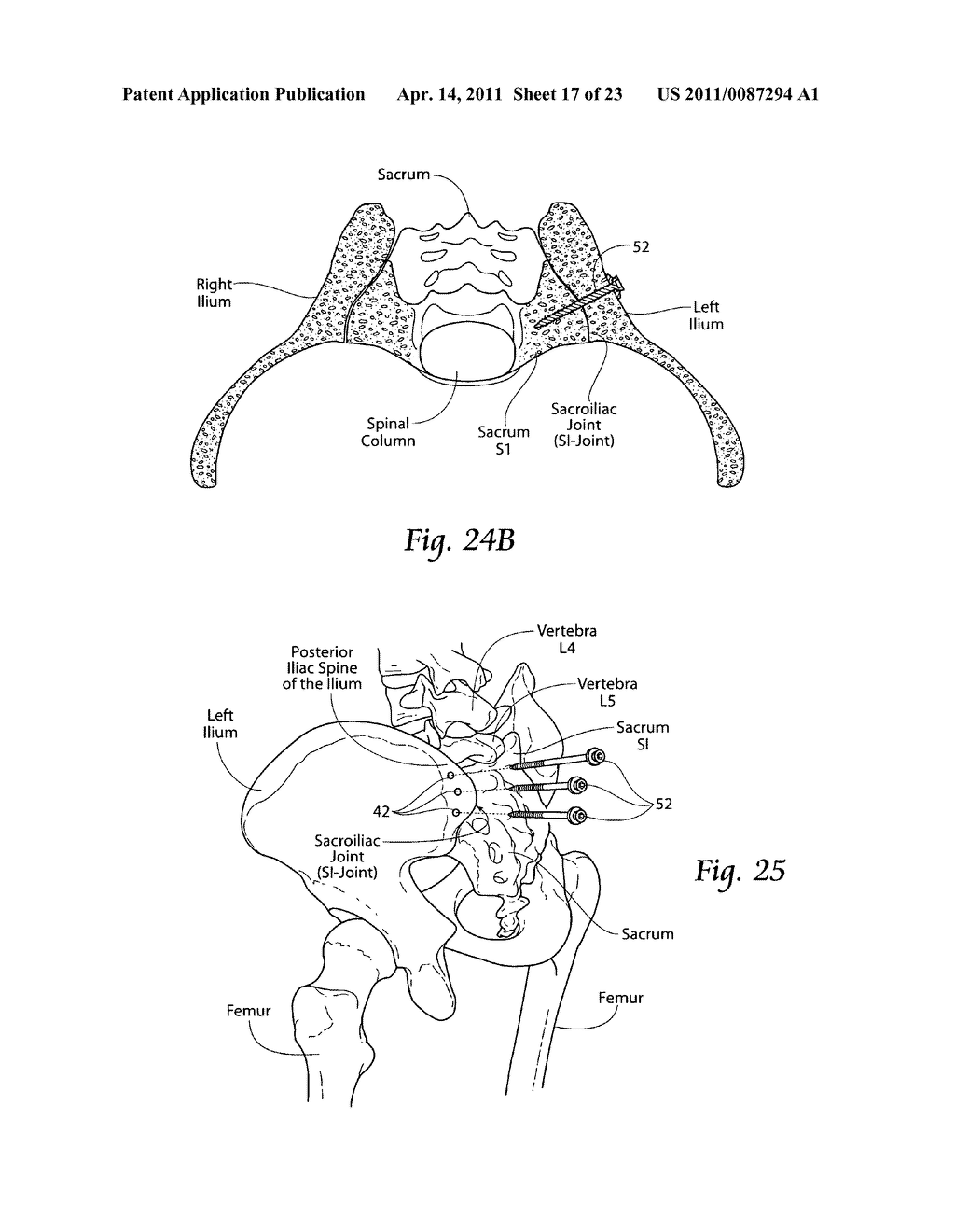 Systems and methods for the fusion of the sacral-iliac joint - diagram, schematic, and image 18