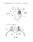 Systems and methods for the fusion of the sacral-iliac joint diagram and image