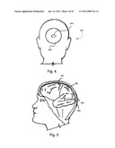 Implantable Interface for a Medical Device System diagram and image