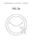 Apparatus for Mitral Lifting Annuloplaty diagram and image