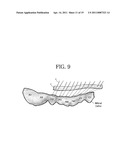 Apparatus for Mitral Lifting Annuloplaty diagram and image