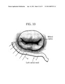 Apparatus for Mitral Lifting Annuloplaty diagram and image