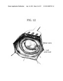 Apparatus for Mitral Lifting Annuloplaty diagram and image