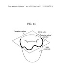 Apparatus for Mitral Lifting Annuloplaty diagram and image