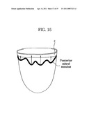 Apparatus for Mitral Lifting Annuloplaty diagram and image