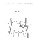 APPARATUS FOR CONTROLLING FLOW IN A BODILY ORGAN diagram and image