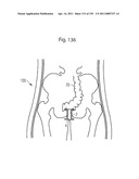 APPARATUS FOR CONTROLLING FLOW IN A BODILY ORGAN diagram and image