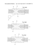 APPARATUS FOR CONTROLLING FLOW IN A BODILY ORGAN diagram and image