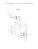 APPARATUS FOR CONTROLLING FLOW IN A BODILY ORGAN diagram and image