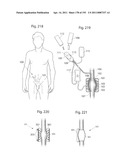 APPARATUS FOR CONTROLLING FLOW IN A BODILY ORGAN diagram and image